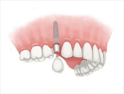Implant