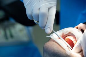 Wisdom Tooth Extraction