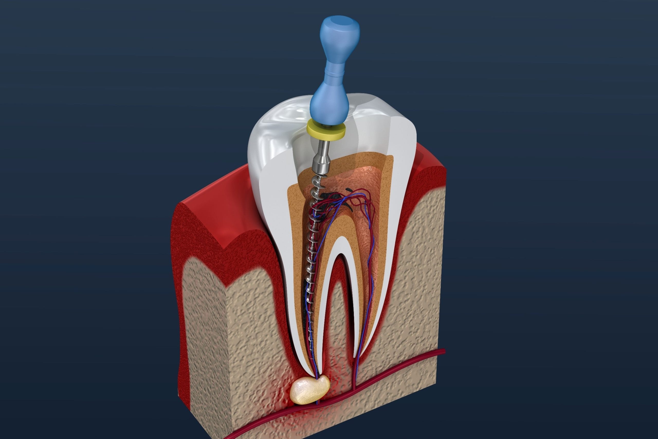 Retreatment of Root Canals