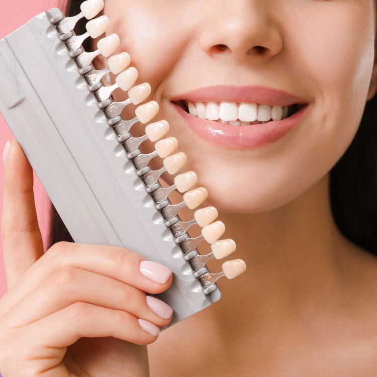 What Are Dental Veneers?