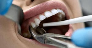 Bleeding After Tooth Extraction