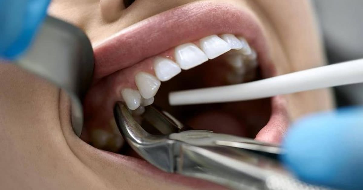 Bleeding After Tooth Extraction