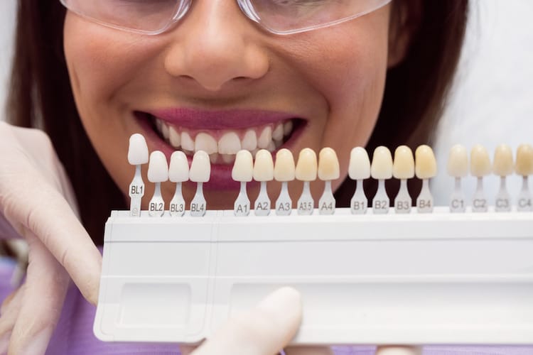 different types of dental veneers