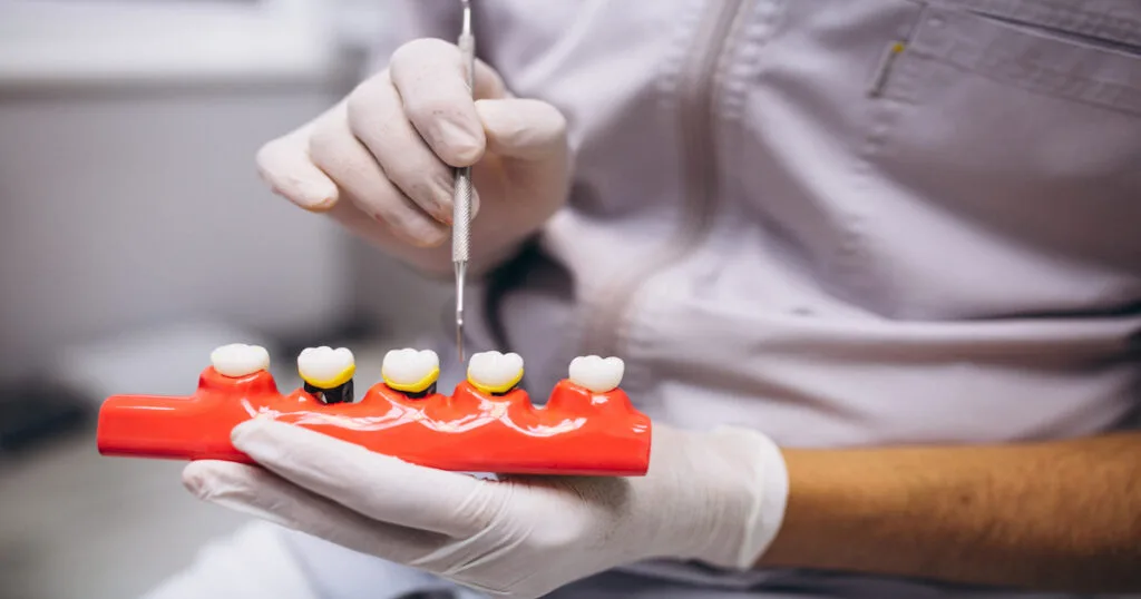 Types of Dental Implants: A Complete Guide for Canadians