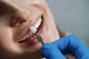 various types of dental veneers