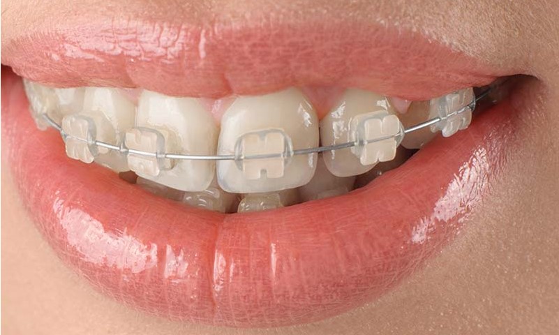 Clear Braces