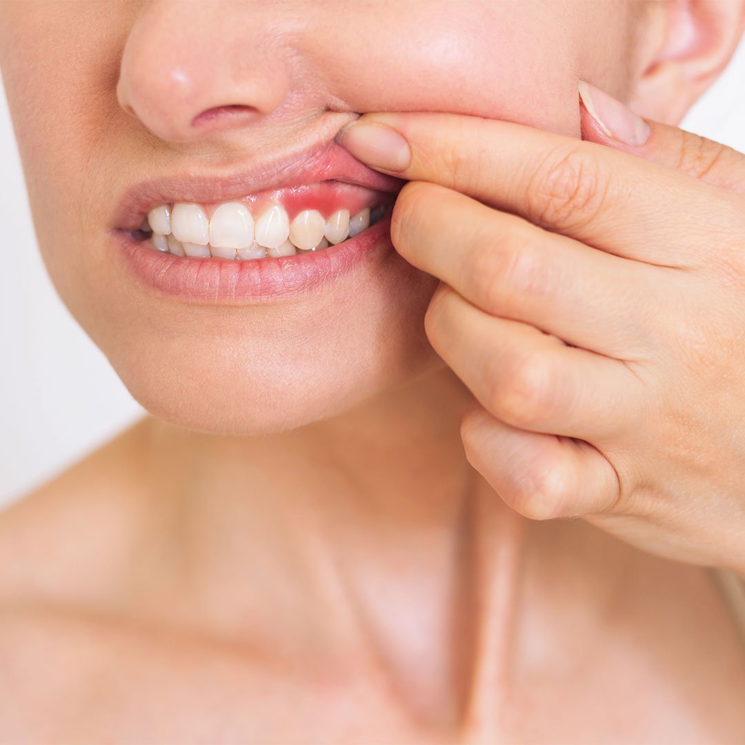 Gum diseases