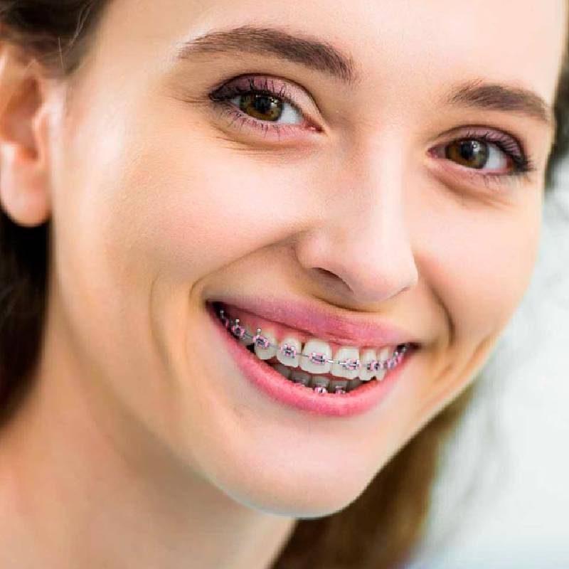 Various Types of Orthodontic Treatments in Newmarket