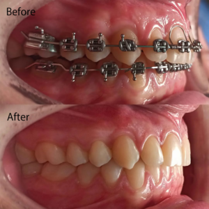 Process of orthodontic with before and after
