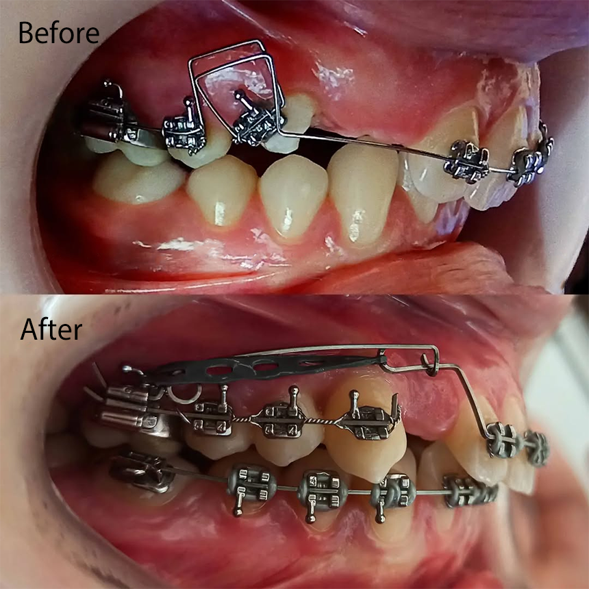 prosses of orthodontic with befor and after