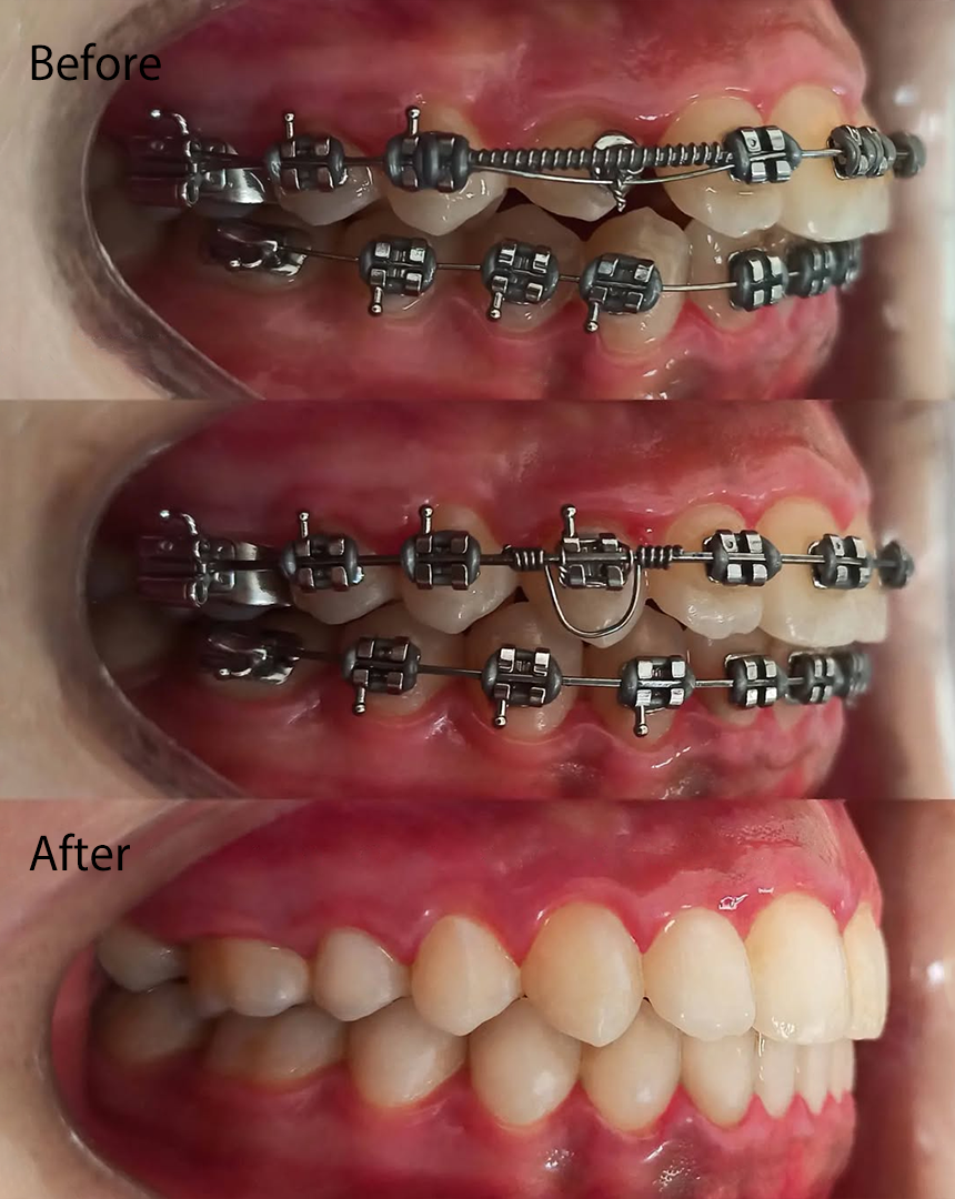 prosses of orthodontic with befor and after