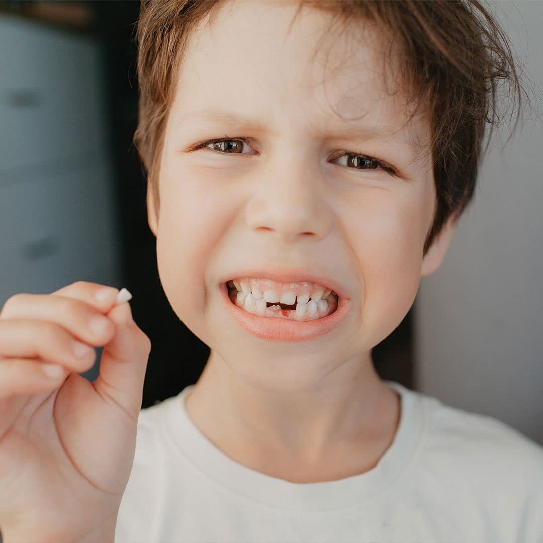 Pre-care-for-Broken-or-Chipped-Teeth