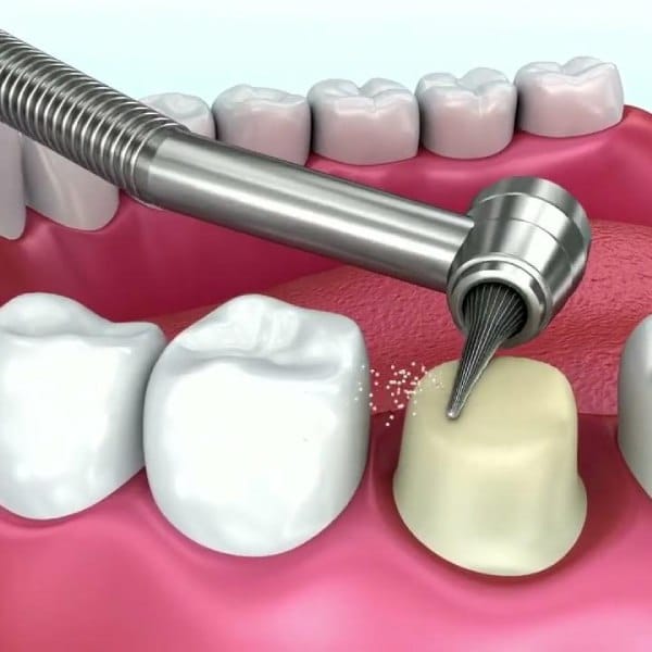 When Do You Need Dental Fillings?