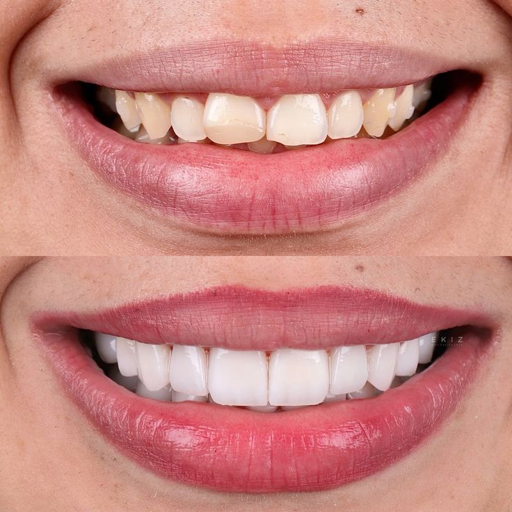 Composite veneer before after