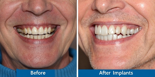 Dental Implants before and after