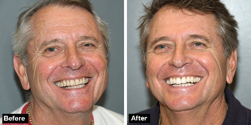 Dental Implants before and after