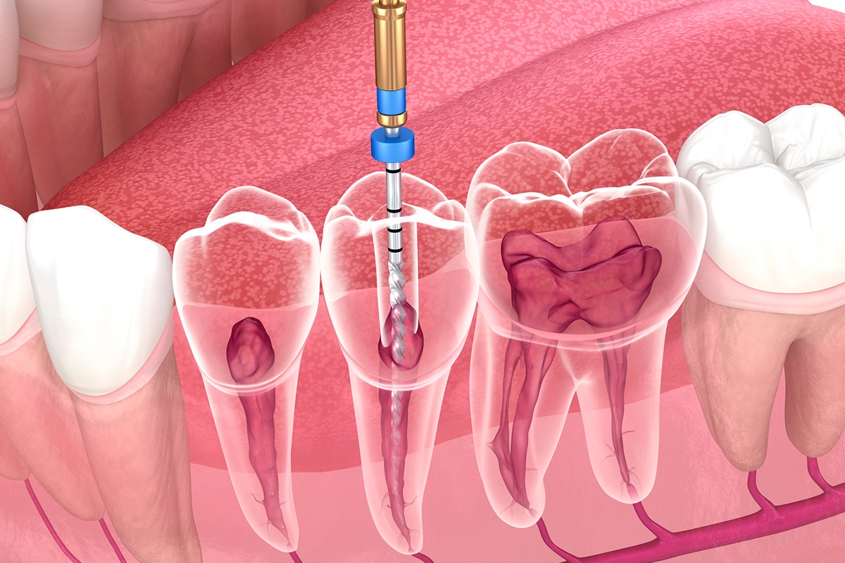 endodontic treatment