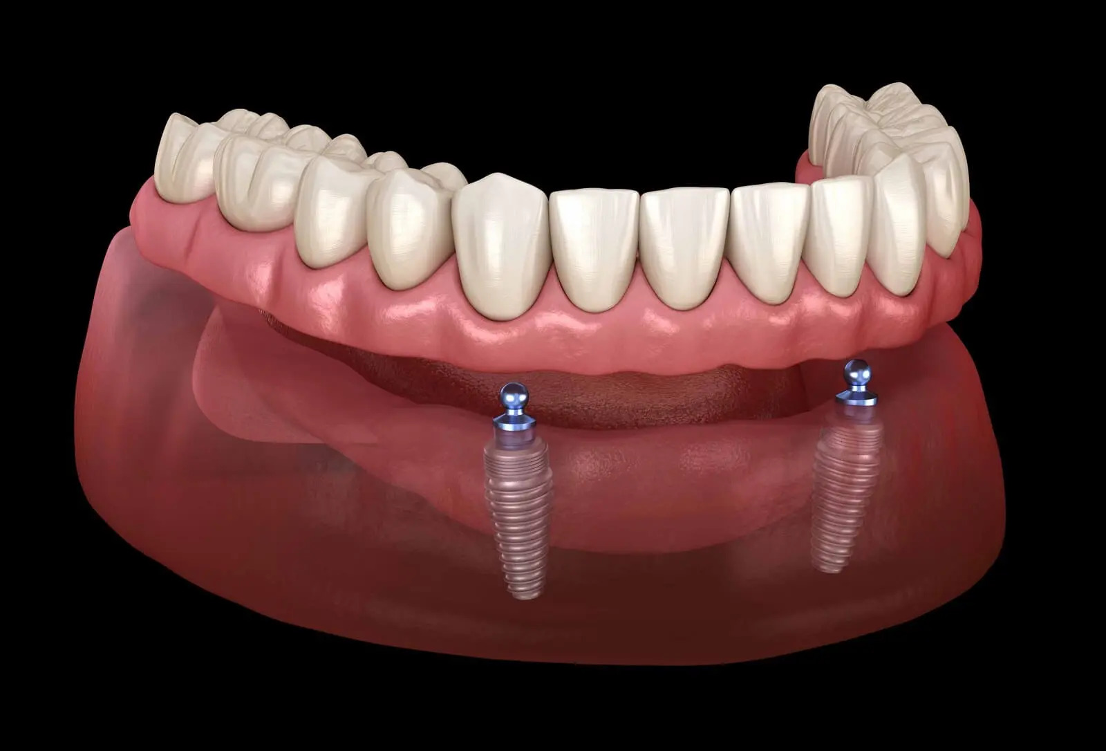 implant supported dentures