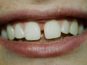 Dental bonding fixes teeth gap.