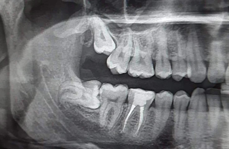 Fully erupted wisdom tooth