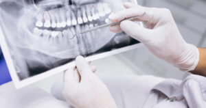 Root Canal vs. Tooth Extraction