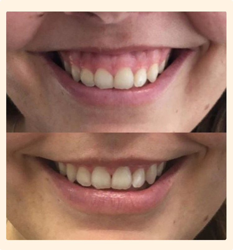 Make your gummy smile beautiful.