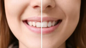 gum contouring