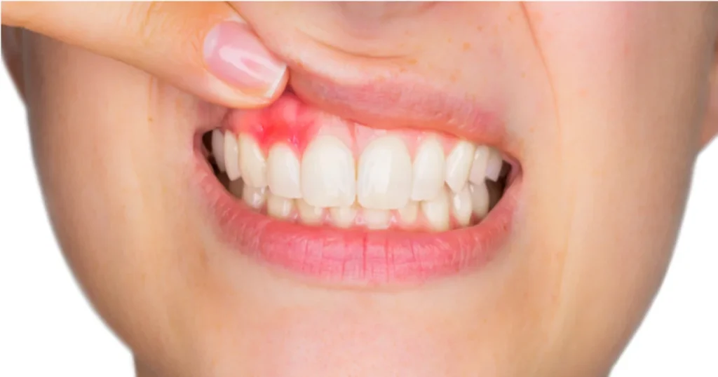 An image of a dentist holding the patient's upper lip to examine the gum abscess