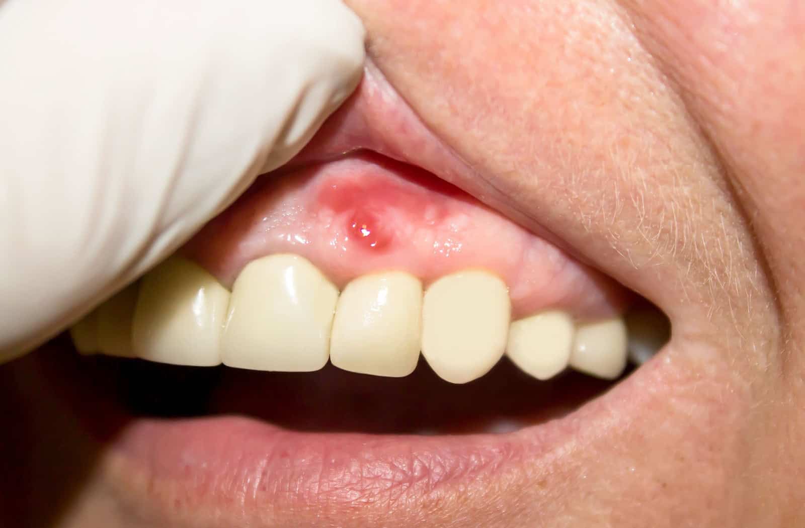 Canker Sores