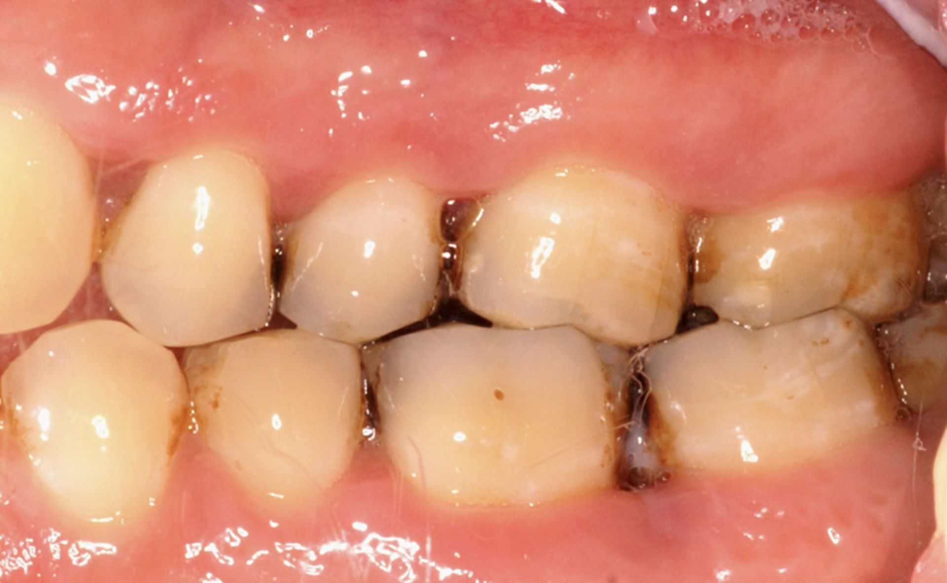 casuse of gums hurt in one spot: food impaction or trapped debris