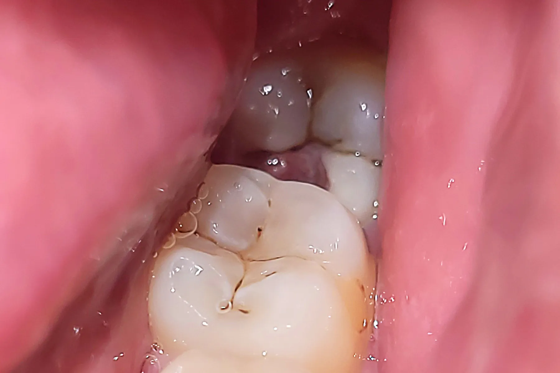 Erupting Wisdom Teeth (Pericoronitis)