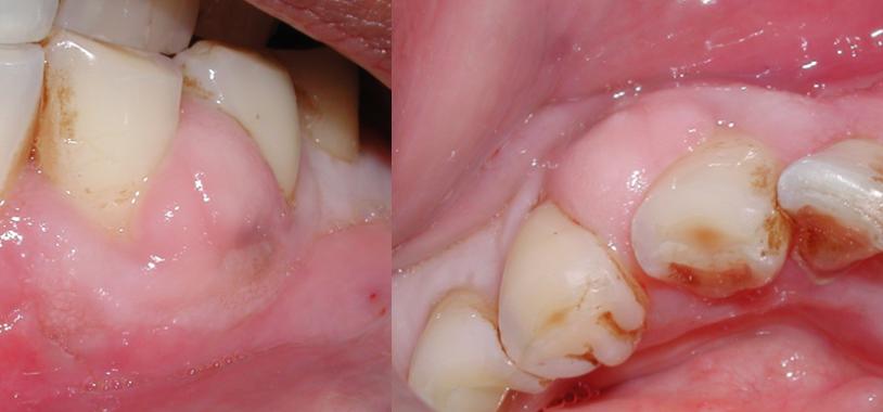 Localized Periodontal Abscess