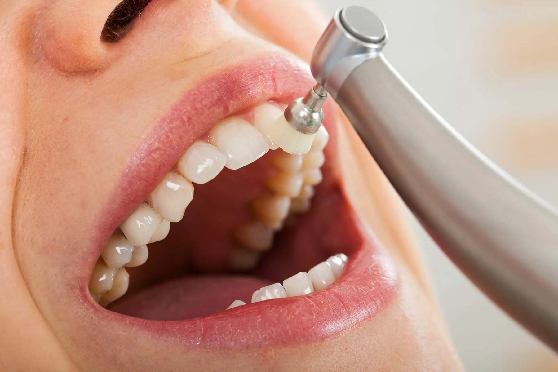 teeth cleaning costs Toronto