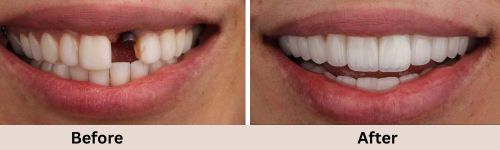 implant-before-and-after-3