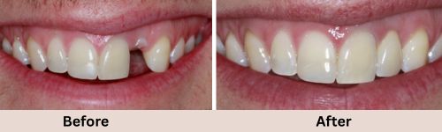 implant-before-and-after-4