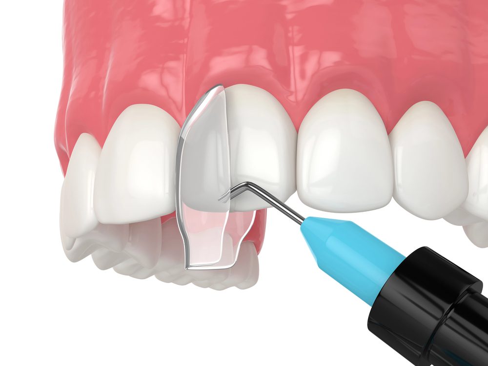 dental bonding