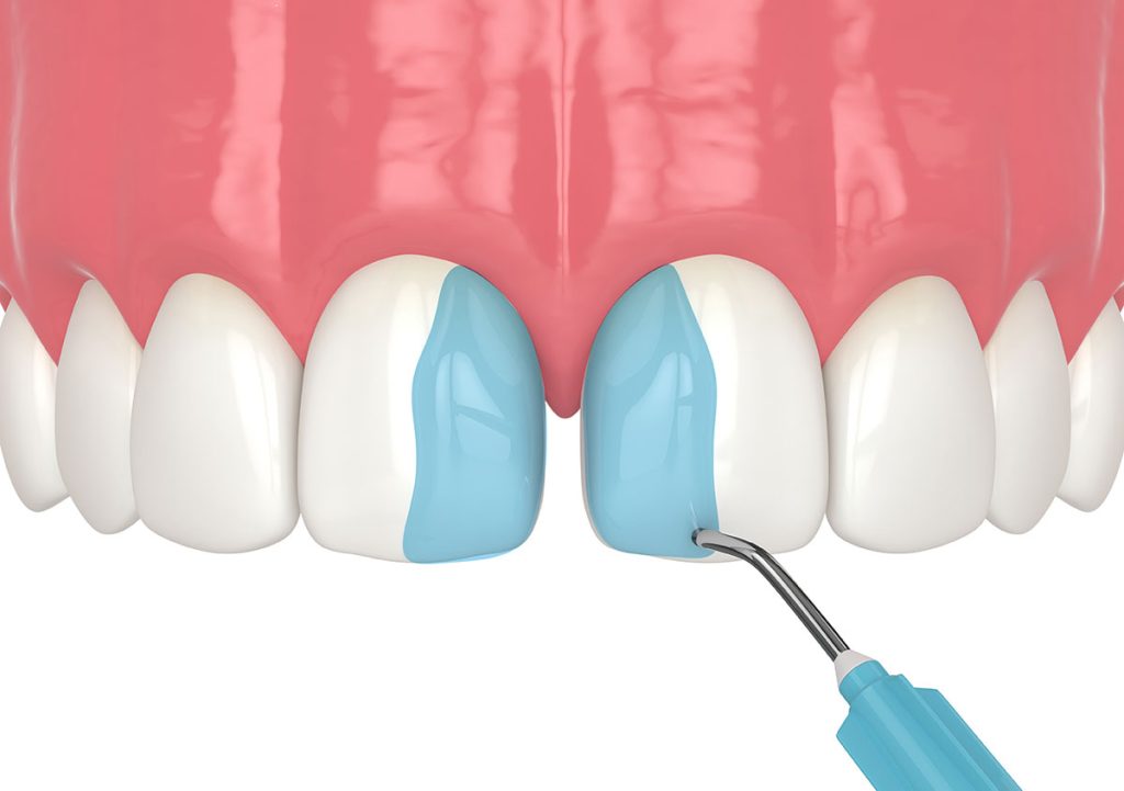 Bonding is an effective solution for gapped teeth