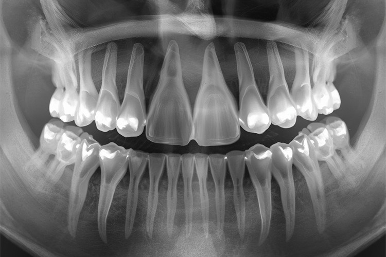 Dental X-ray showing wisdom teeth growth age and developing third molars