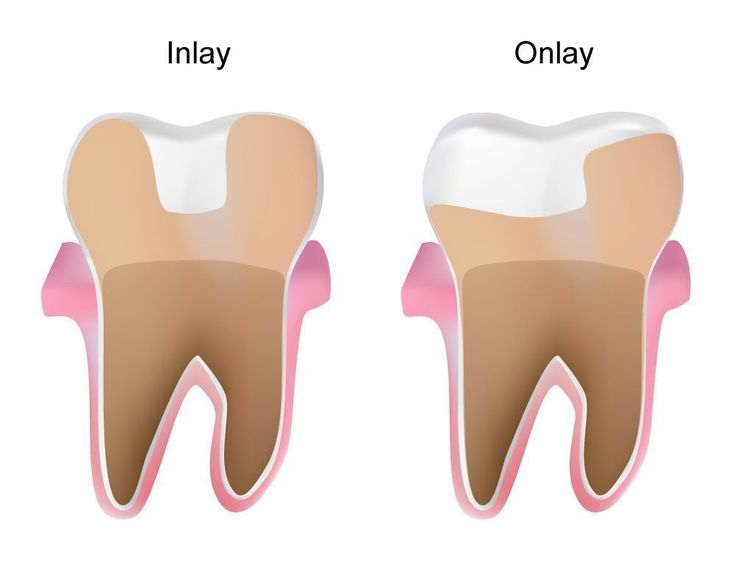 Inlays onlays difference