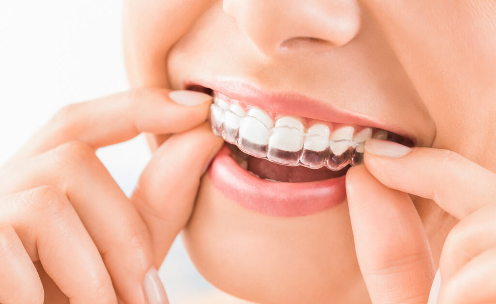 Benefits of choosing Invisalign over metal braces
