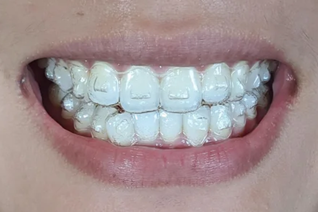 Invisalign treatment time