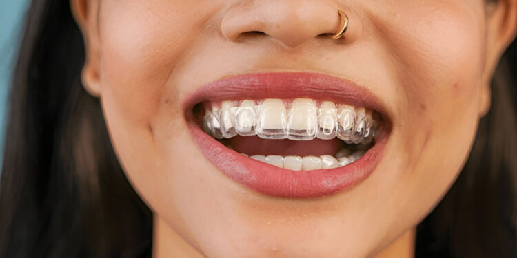 Why is Invisalign perfect for adults?