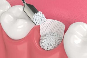 Bone graft