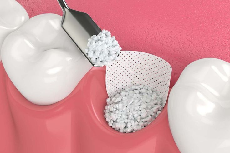 Bone graft