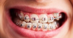 metal braces and benefits of orthodontic treatment