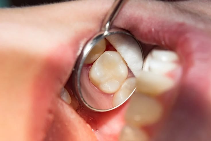 Composite Dental Filling