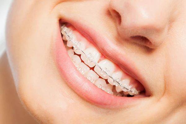 ceramic braces as an alternative to traditional metal braces
