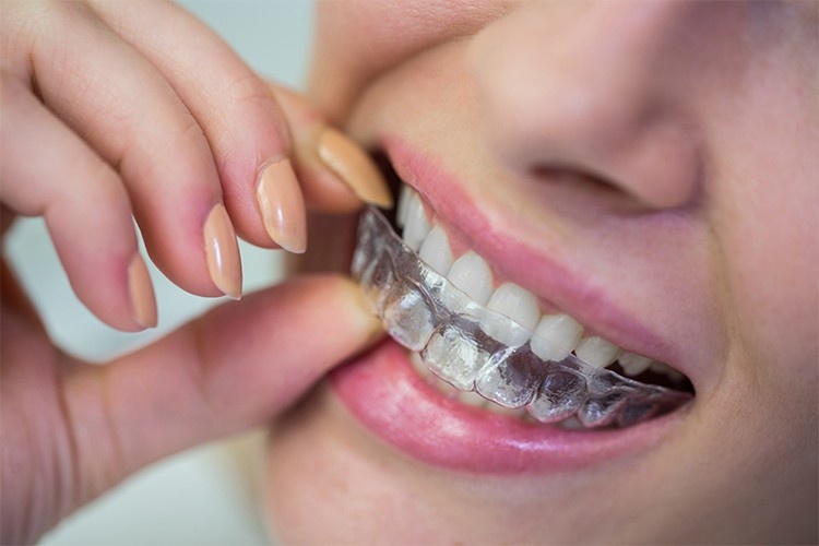 a girl wears clear trays as one of the most popular orthodontic treatment options