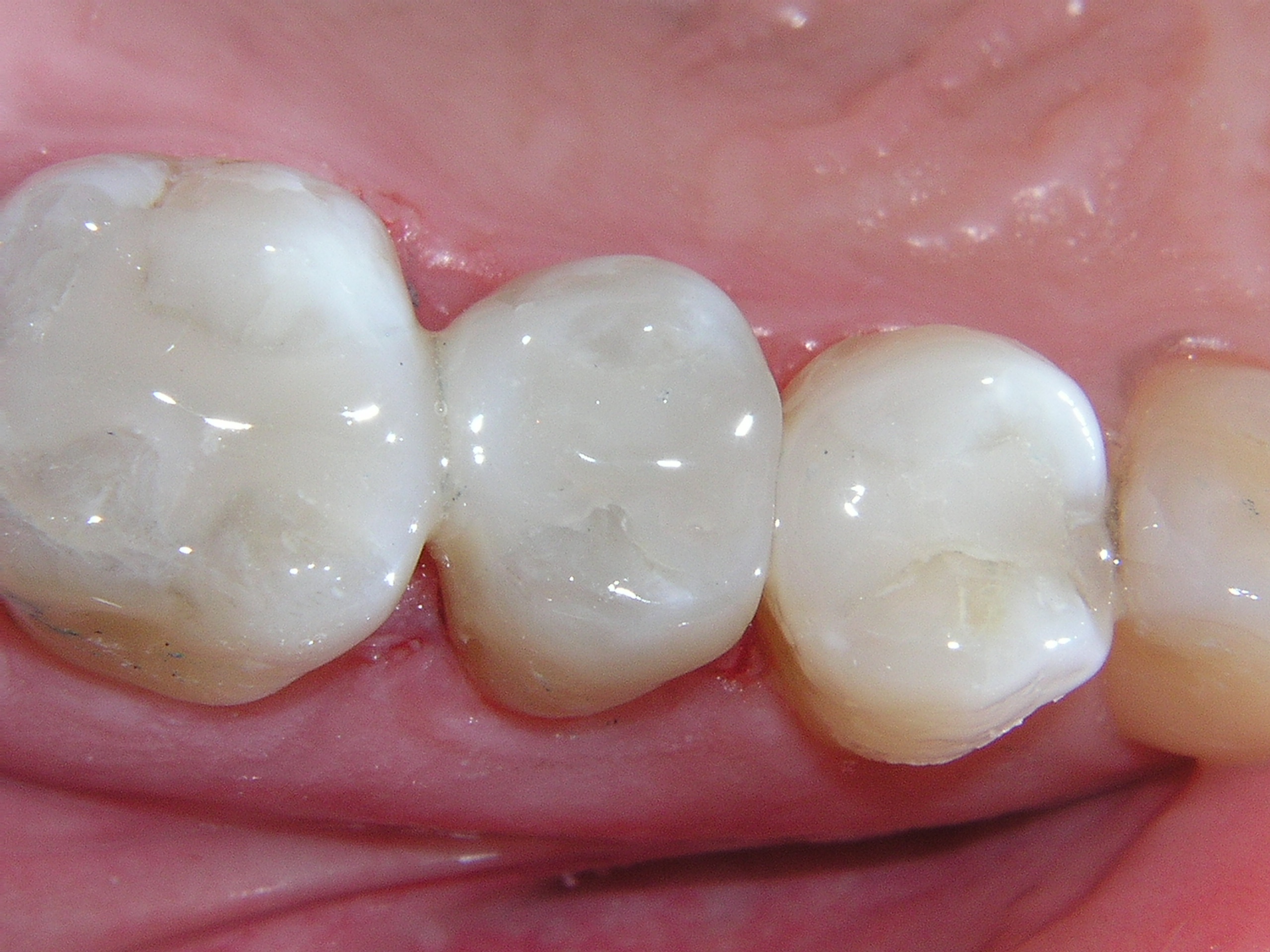 Tooth colored filling