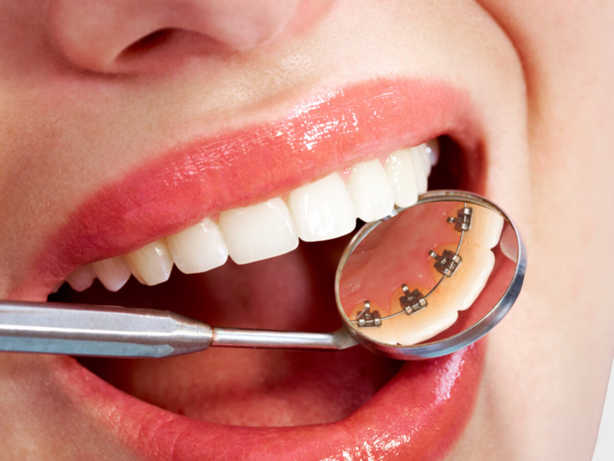 lingual braces as an alternative to traditional metal braces